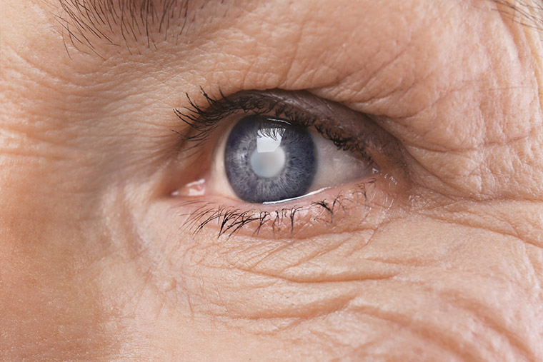 Quels sont les principaux signes de la cataracte à Lyon dans le Rhône, Lyon, Docteur Ygal Boujnah
