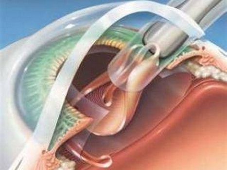 Quels sont les risques et les effets secondaires de la chirurgie de la cataracte ?, Lyon, Docteur Ygal Boujnah
