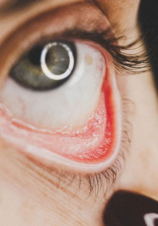 Sécheresse oculaire et chirurgie laser : est-ce compatible ?, Lyon, Docteur Ygal Boujnah